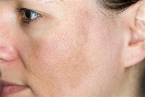 The skin benefits of Azelaic Acid - Reviva Labs