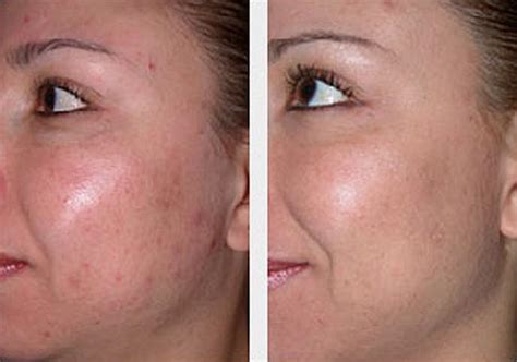 Microdermabrasion Blackheads Before And After