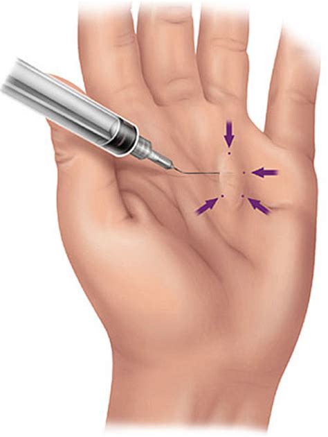 Dupuytren's Contracture Alternative Treatment at Ryan Shipp blog