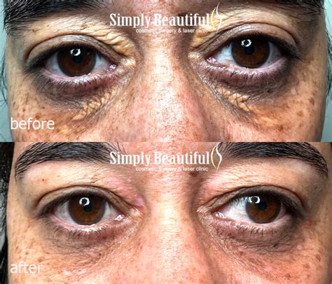 Laser Xanthelasma Removal - Dr Peter Kim Surgery - Skin Cancer ...