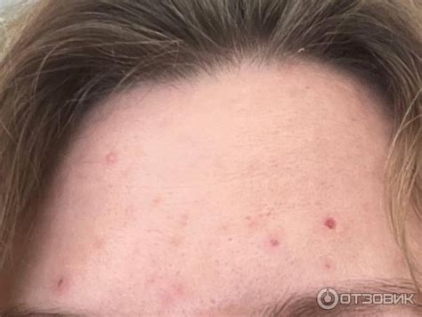 Отзыв о Гель для лечения рубцов и удаления растяжек Контрактубекс ...
