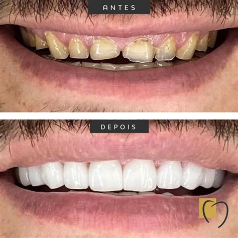 facetas esteticas dr robson carvalho