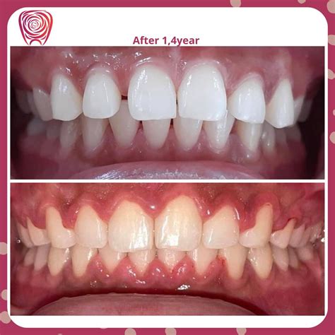 result – Cuticul Dental Clinic