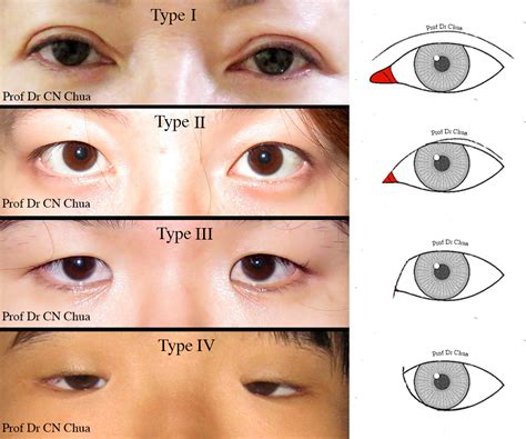 Epicanthal Folds Vs Normal