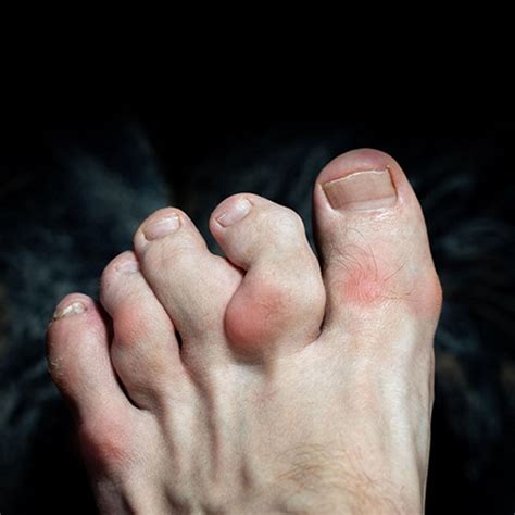 Arthritis Treatment | Leading Edge Podiatry in Blackwood & Adelaide Hills