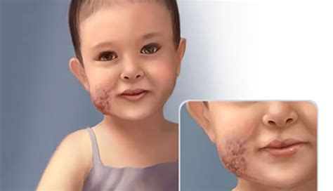 Venous Malformation | Johns Hopkins Medicine