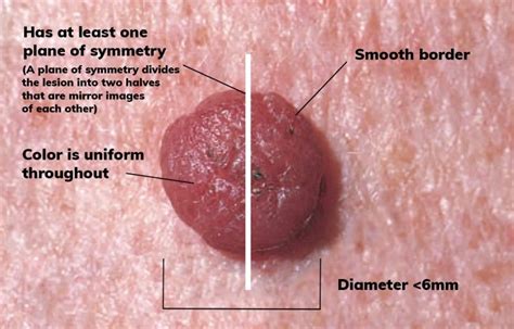 Identifying Mole vs. Melanoma: Critical Differences That Could Save ...