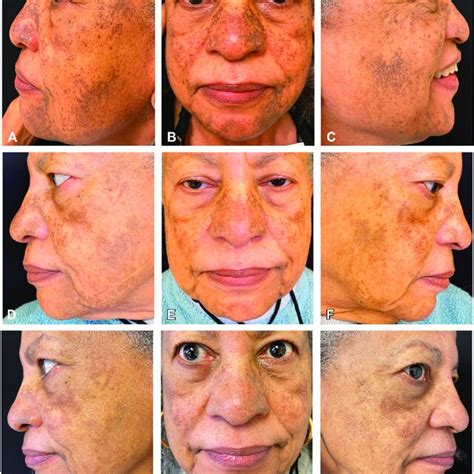 prior  therapy  patient  hundreds  dark brown  gray brown