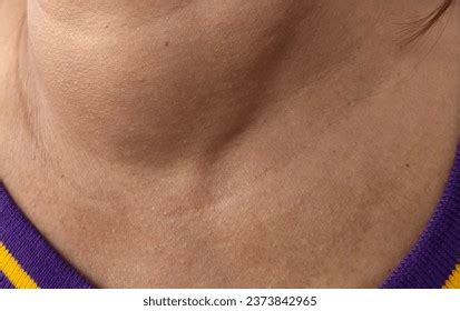 big neck closeup neck asian swelling stock photo  shutterstock