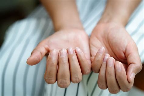 Ломкость, лунки и точки: 10 примеров, как по ногтям понять, что ...