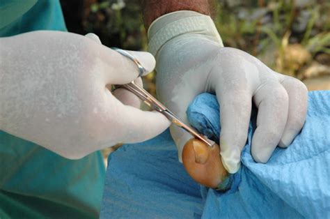 Ingrown Toenail Surgery - The Foot and Ankle Clinic
