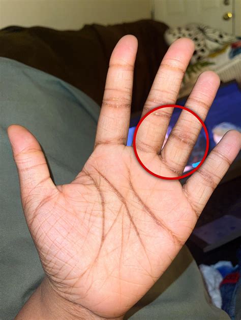 Hard mountain-like craters in my hand and feet. : r/Dermatology