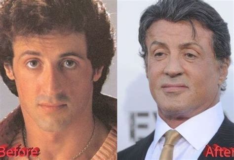 Sylvester Stallone's Transformation: Before and After Plastic Surgery