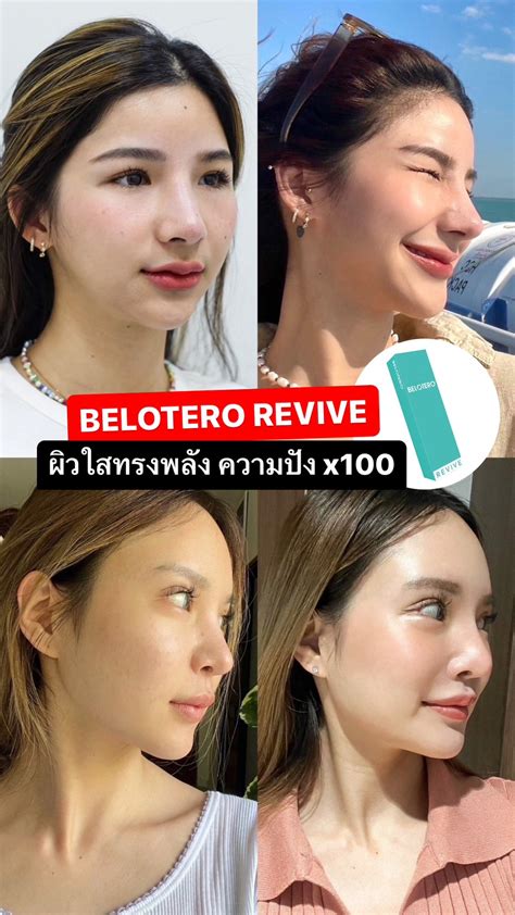 BELOTERO REVIVE ฟิลเลอร์นางฟ้า งานผิวหน้า 4 มิติ | LBC Clinic