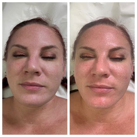 long  hydrafacial results  maximizing  glow