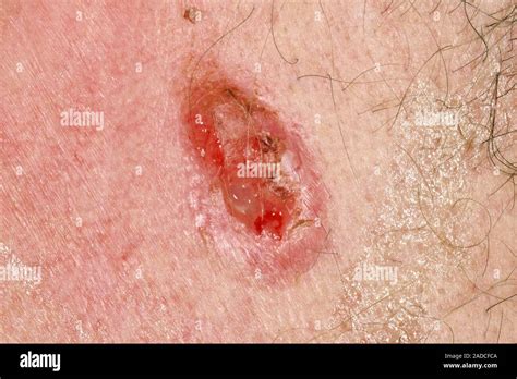 Nodular infiltrative basal cell carcinoma skin cancer. Close-up of a ...