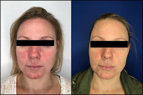 Forever Young BBL - Chesapeake Laser and Skin Care Center