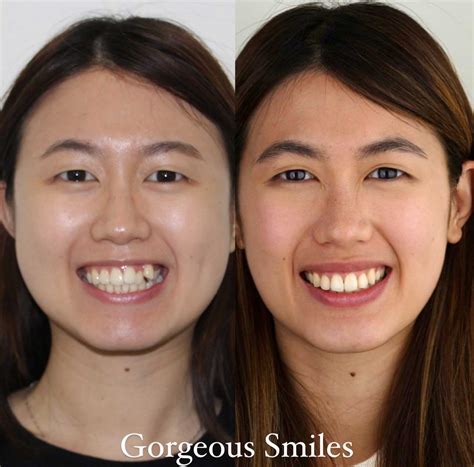 Braces Gummy Smile Before And After at JENENGE blog
