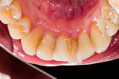 tooth plaque  prevention  treatments