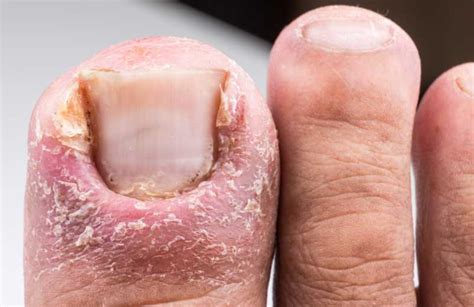 Mycose des ongles de pied : meilleurs traitements naturelles ! - Ortho ...