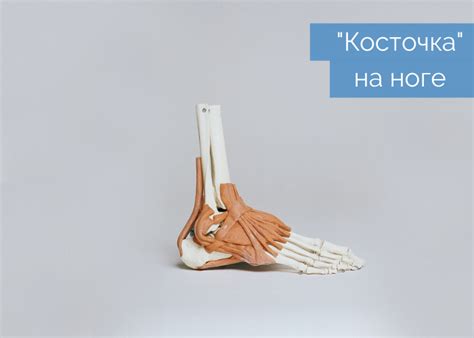 “Косточка на ноге” Вальгусная деформация большого пальца стопы ...