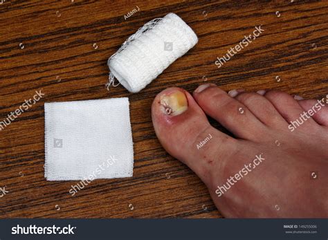 224 Ingrown Toenail Removal Stock Photos, Images & Photography | Shutterstock