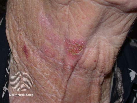 Squamous Cell Carcinoma: Symptoms and Treatment | Pinnacle Dermatology