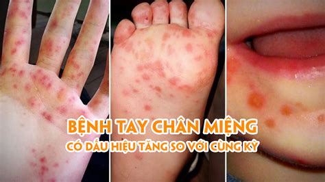 benh tay chan mieng  dau hieu tang  hau giang truyen hinh hau giang