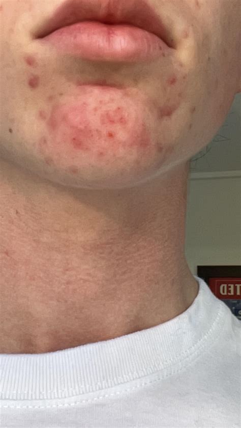I only get acne around my chin, i’ve tried different products and i