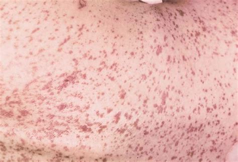 Early Stevens Johnson Syndrome A Case Of Stevens–Johnson Syndrome In