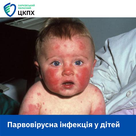 Парвовірусна інфекція у дітей - Статті - Харківський обласний центр ...