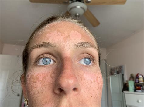 how to keep sunburn from peeling 1