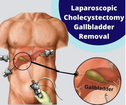 laparoscopic cholecystectomy kalyanihospitalcoin