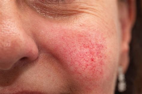 Rhinophyma treatment, prevention strategies