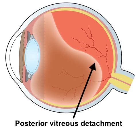 Posterior Vitreous Detachment Floaters