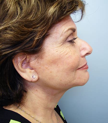 Photo Gallery - Facelift Case 3 | Dr. Vivian Hernandez