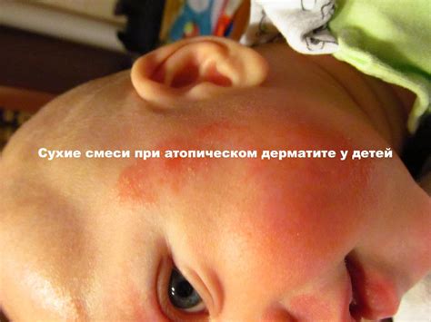 Соевые смеси при атопическом дерматите: какую выбрать