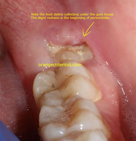 7 Signs Of An Infected Wisdom Tooth To Watch Out For