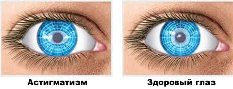 Ношение контактных линз при астигматизме - советы и рекомендации