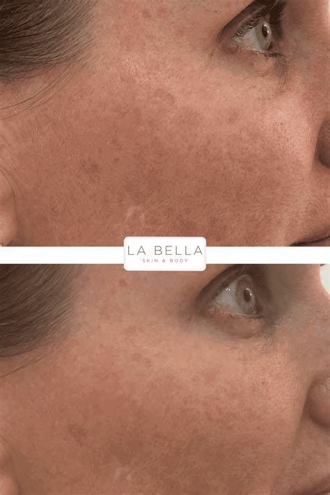 Pigmentation/Melasma | La Bella Skin + Body