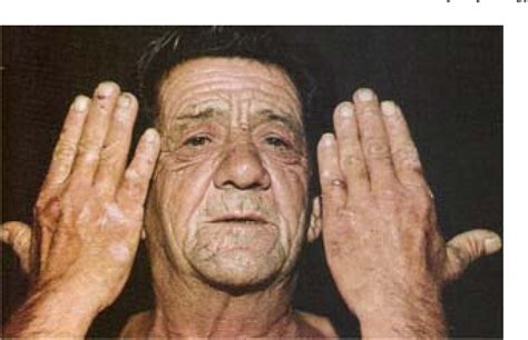 Figure 13 from Skin manifestations of liver diseases. | Semantic Scholar