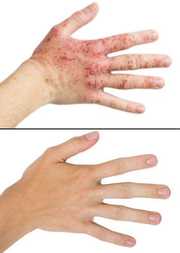 rashes dermatologist  west yarmouth ma cape  dermatology llc