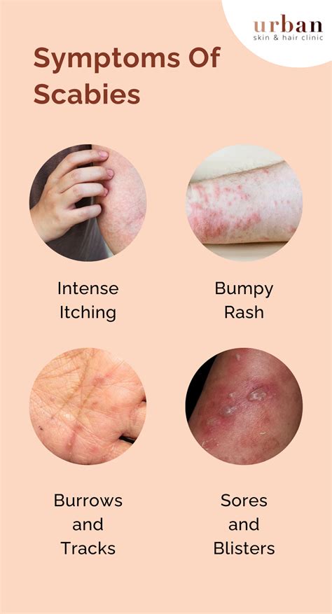 Scabies Types, Causes, Symptoms & Treatment - Urban Skin and Hair Clinic