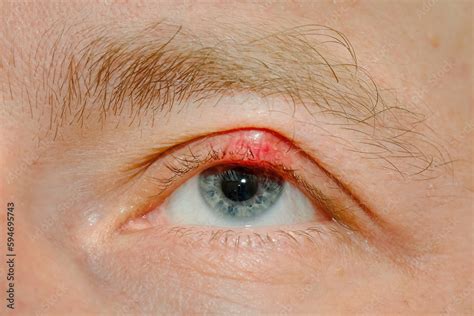 Eye sick, eyelid sick. Demodicosis mite diseas, demodex. Chalazion on ...