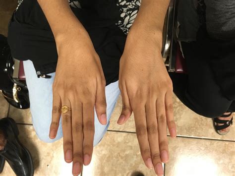 Familial Marfan Syndrome | Consultant360