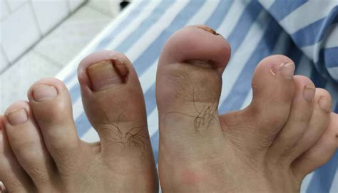 Different ingrown toenails photos and causes - Better Toenail