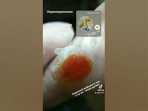 Натоптень та СТРИЖЕНЬ мозолі / натоптыш и стержневая мозоль на стопе ...