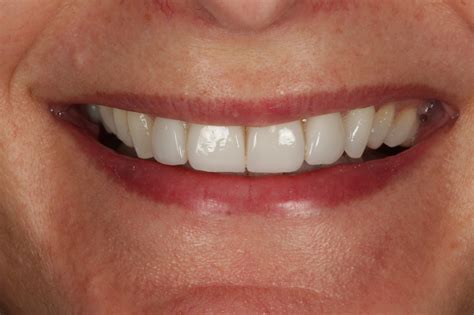 Everything you need to know about veneers — Nova Smiles