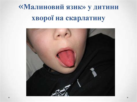 Інфекційні екзантеми. Етіологія. Диференційна діагностика - презентация ...