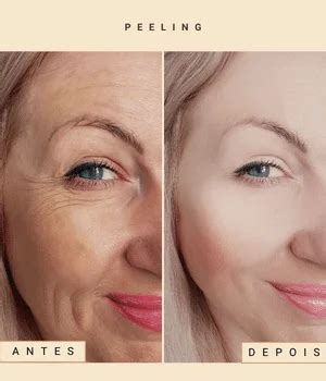 Peeling De Hollywood Antes E Depois - Peeling de Hollywood – Black peel - marciabrasil.com.br